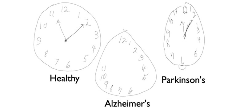 Digital pen drawings from people with healthy and affected brains