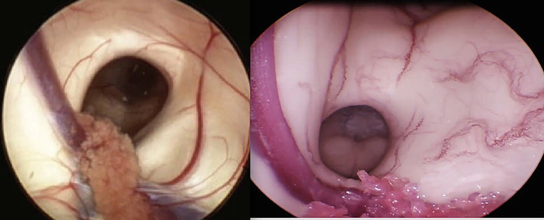 A side-by-side image of a real patient brain (Left) undergoing ETV surgery as compared to the Fractured FX brain (Right) during the same critical moment of the procedure. (PRNewsFoto/Boston Children's Hospital)