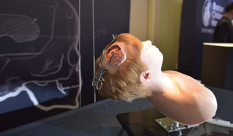 This image shows the opening flap made in the scalp to prepare for endovascular third ventriculostomy (ETV) surgery. The trainer, created by Fractured FX, will help train neurosurgeons to successfully execute the delicate surgery. (PRNewsFoto/Boston Children's Hospital)