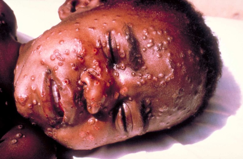 Boy With Smallpox