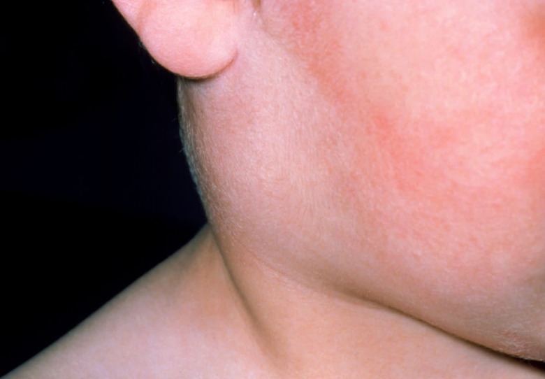 Inflamed parotid gland, child with mumps