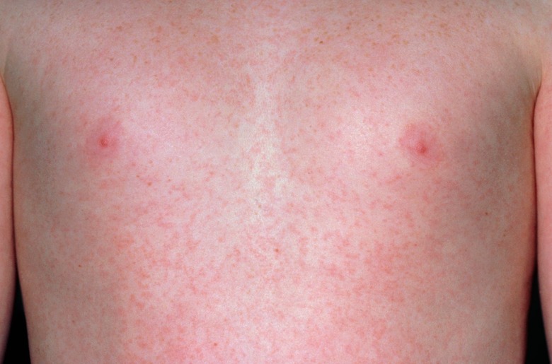 German measles (Rubella) rash on chest of a child