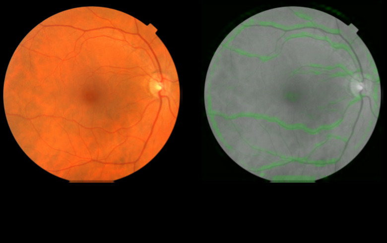 On the left: a sample retinal image from the dataset in color. On the right: attention map indicating areas that support the prediction for high systolic blood pressure in green, which overlap with the retinal blood vessels.
