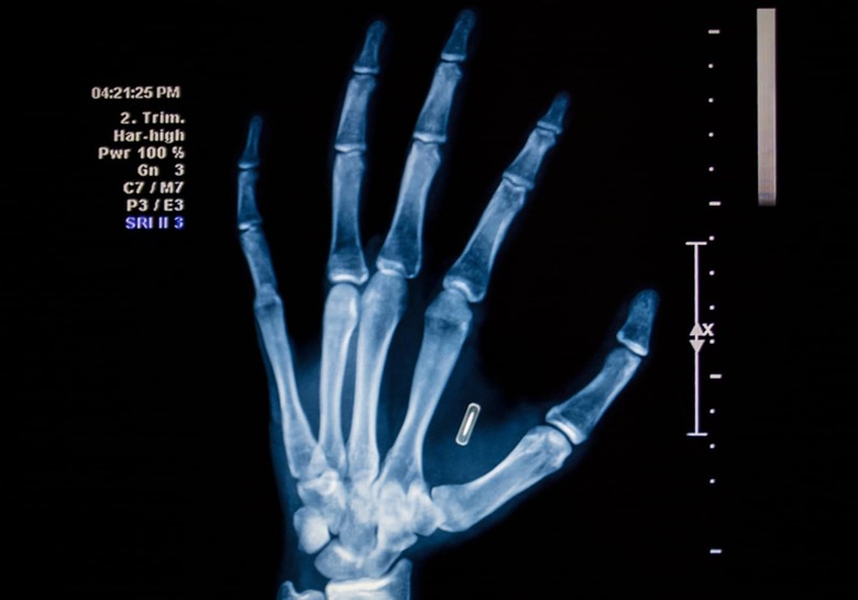 Microchip Hand Implant