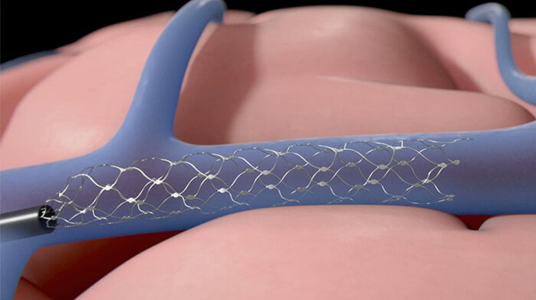 Synchron's Stentrode implant