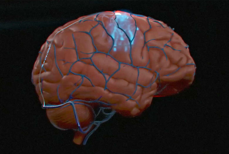 A computer graphics rendering of the Synchron Stentrode brain-computer interface implant.